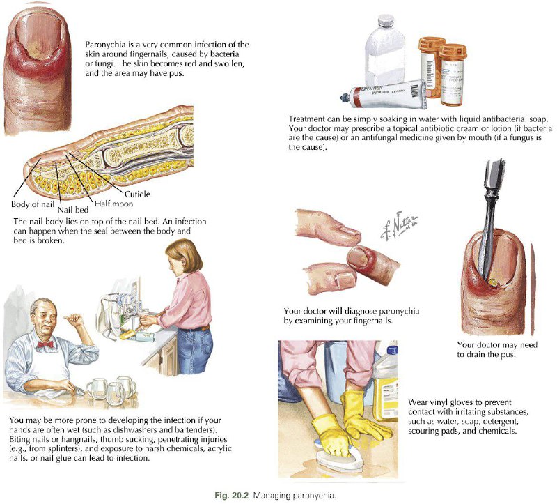 Summary of Managing Paronychia