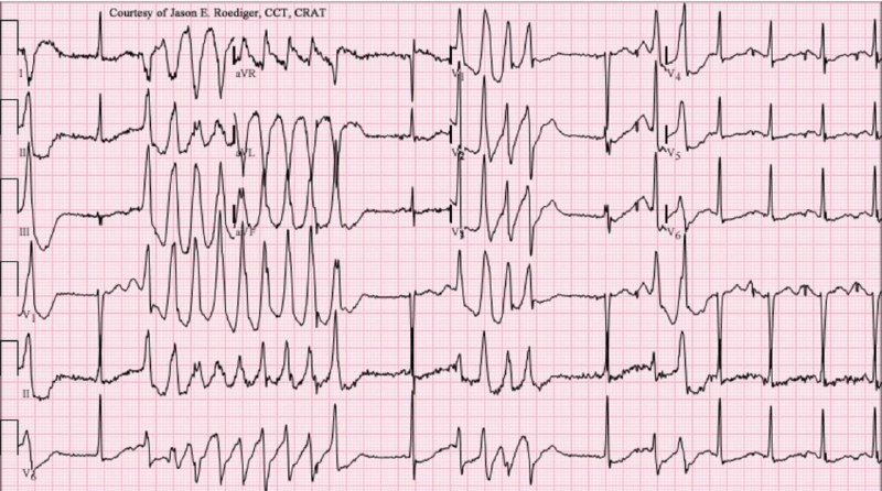 Torsade de pointes