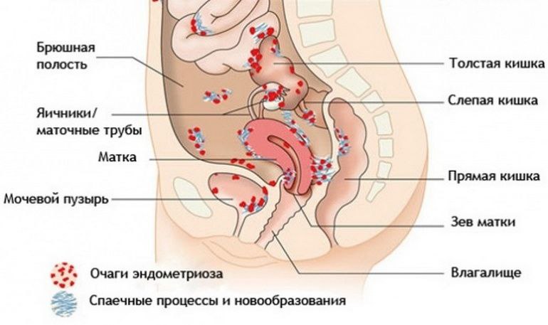 ***📣*** **Эндометриоз-болезнь менструирующих женщин.**