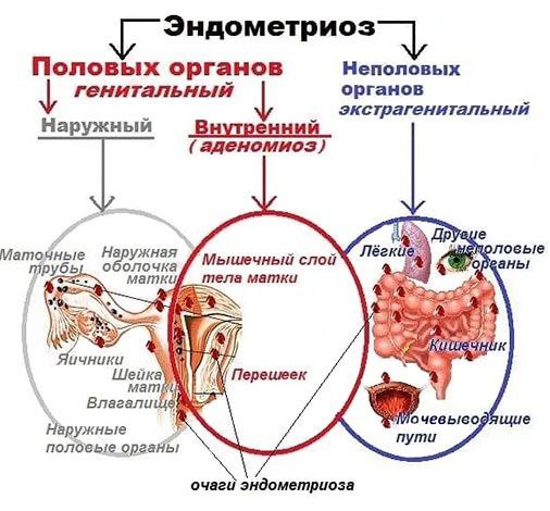 **Лечение эндометриоза.**