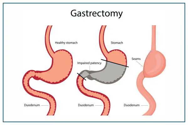 **استئصال المعدة Gastrectomy**