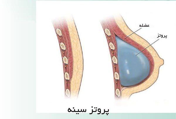 ***🔻***‏پروتز سینه خیلی ترند شده. تقاضای …