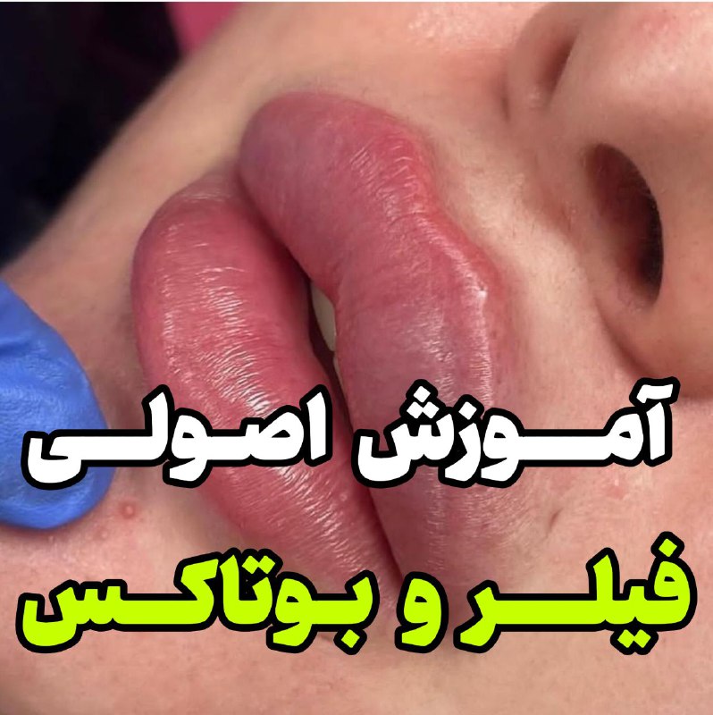 ***✔️*****آموزش رایگان فیلر و بوتاکس**