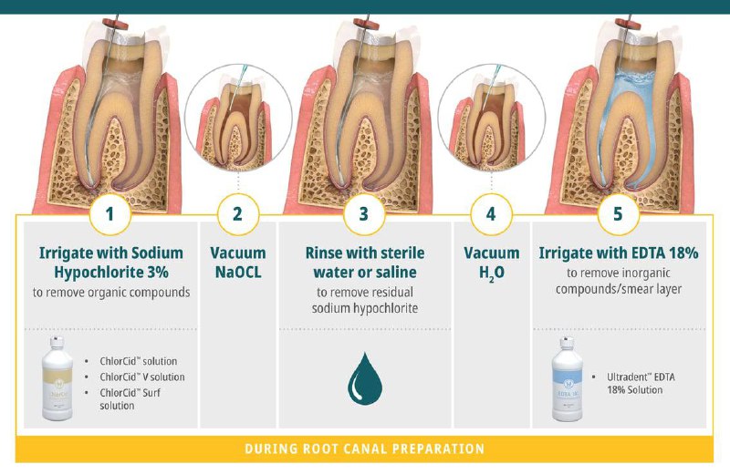 Clinical Guide: protocol in Endodentic irrigation …