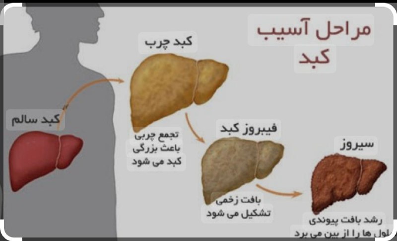***✅******✅******✅***علل‌ایجادکبد چرب چیست؟