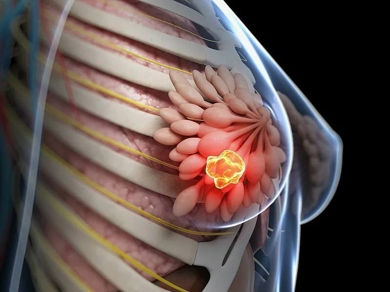 Рак молочной железы: важность ранней диагностики