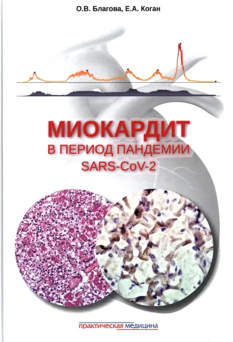 Миокардит в период пандемии SARS-CoV-2. О.В. …
