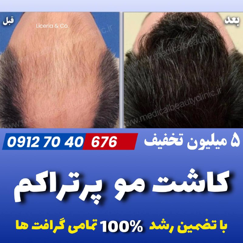 ***‼️*****کاشت مو‌ بالاترین تراکم در یک …