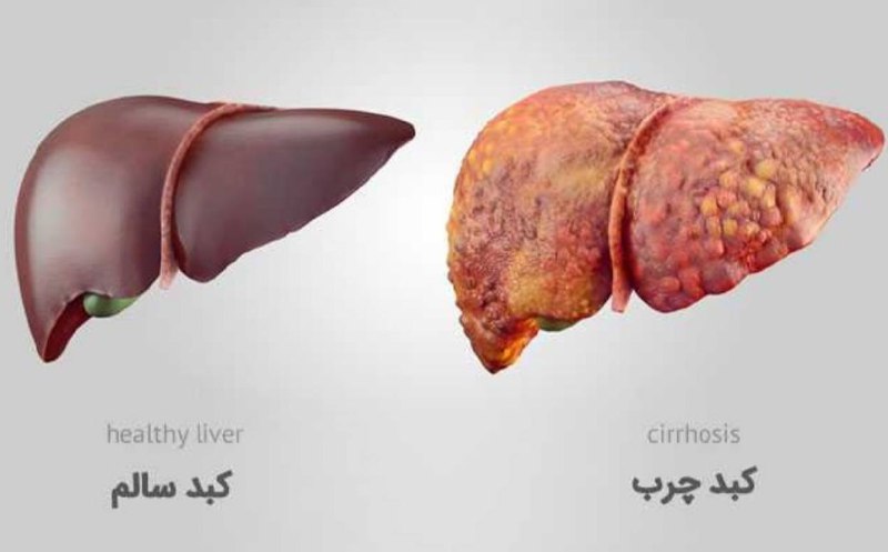 **بهترین راه درمان کبد چرب چیست؟**