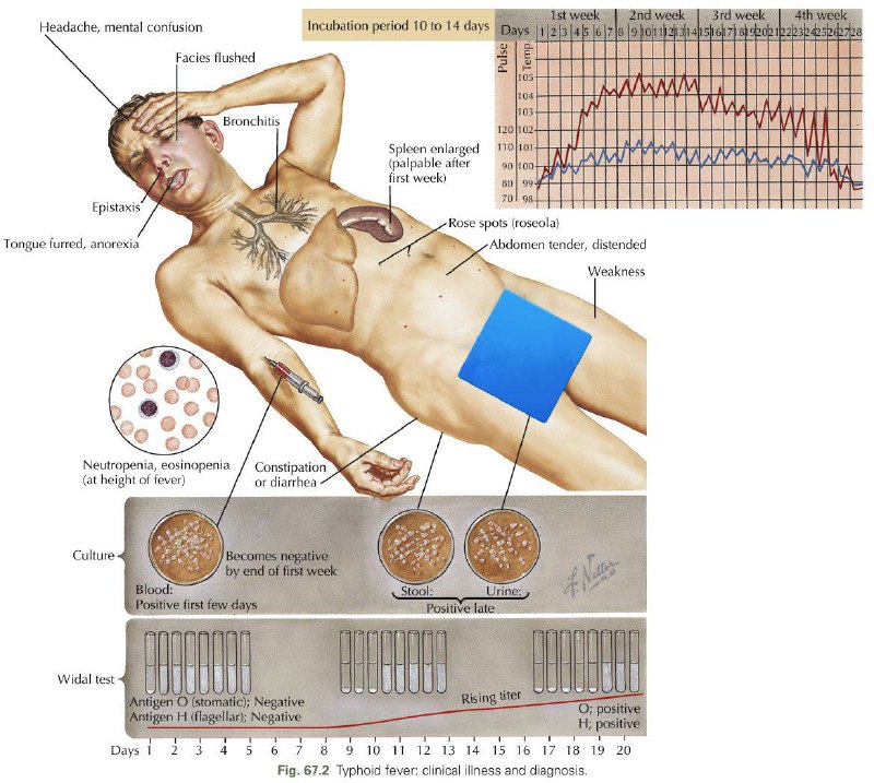 Typhoid Fever: Clinical Illness and Diagnosis