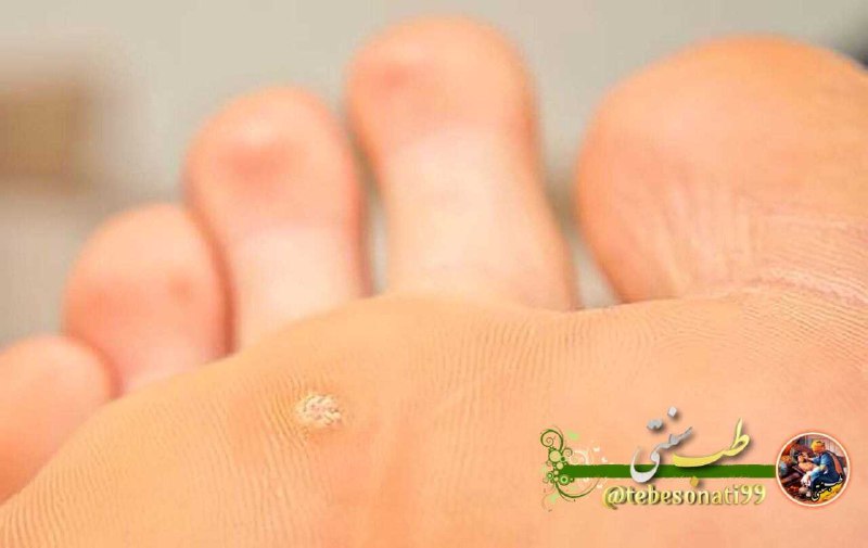 *****⭕️*** درمان قطعی میخچه*****👇***