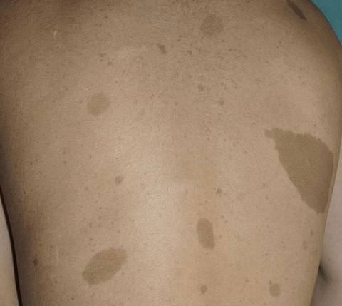 DD of [#Café](?q=%23Caf%C3%A9) au lait spots.