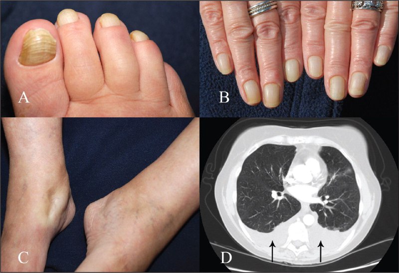 ***🟨***Yellow Nail Syndrome