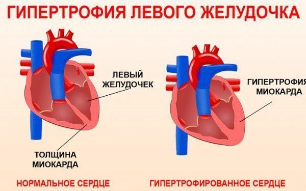 1. ***🔠******🔠******🔠*** означает увеличение толщины сердечной …