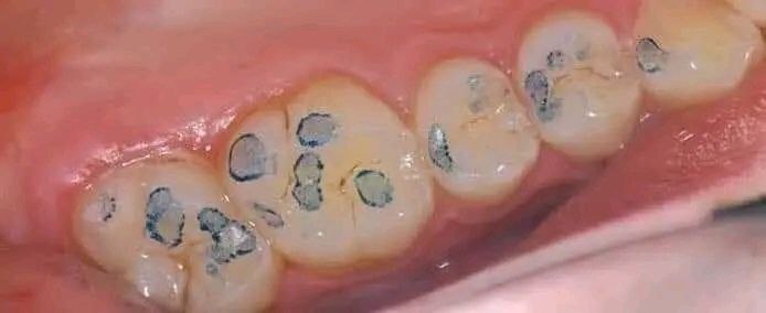 لما بتعمل حشوه جديده وتطلع عاليه …