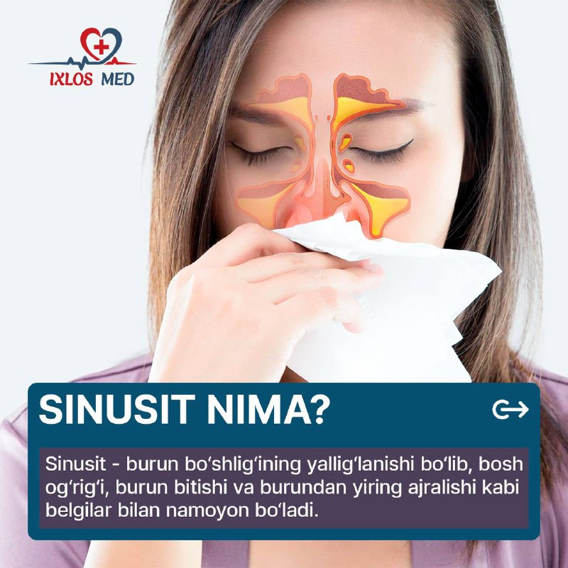 **Sinusit** — bu burun bo’shlig’idagi sinuslarning …