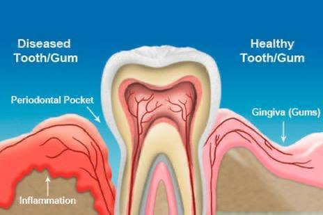 How to Restore Rotten Teeth &amp; …