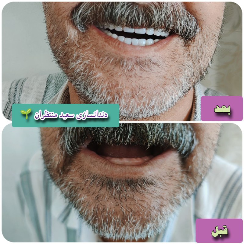 ساخت دندان [#یاماهوچی\_ژاپن](?q=%23%DB%8C%D8%A7%D9%85%D8%A7%D9%87%D9%88%DA%86%DB%8C_%DA%98%D8%A7%D9%BE%D9%86)***??*** برای مراجعه کننده …