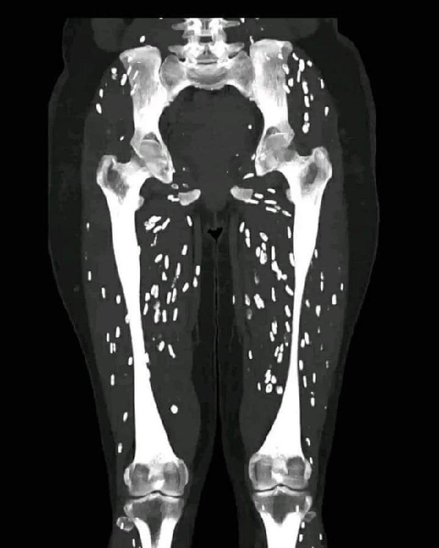 ***◀️******◀️*****تظهر الأشعة المقطعية ساقي مريضة ممتلئتين …
