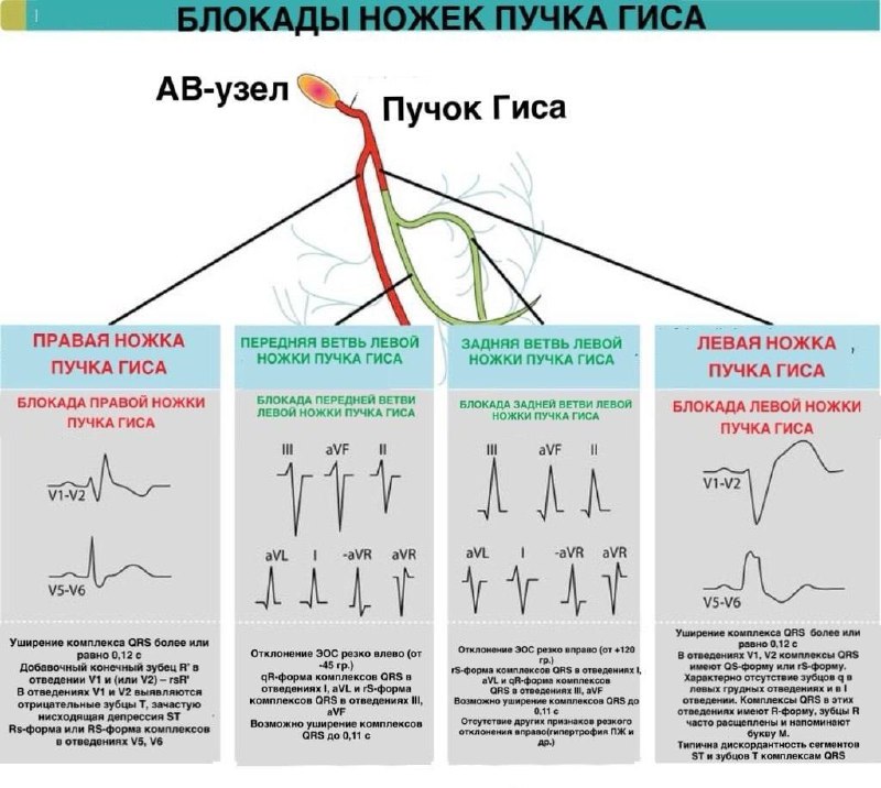 Giss tutami oyoqchalarining blokadasi EKG belgilari.