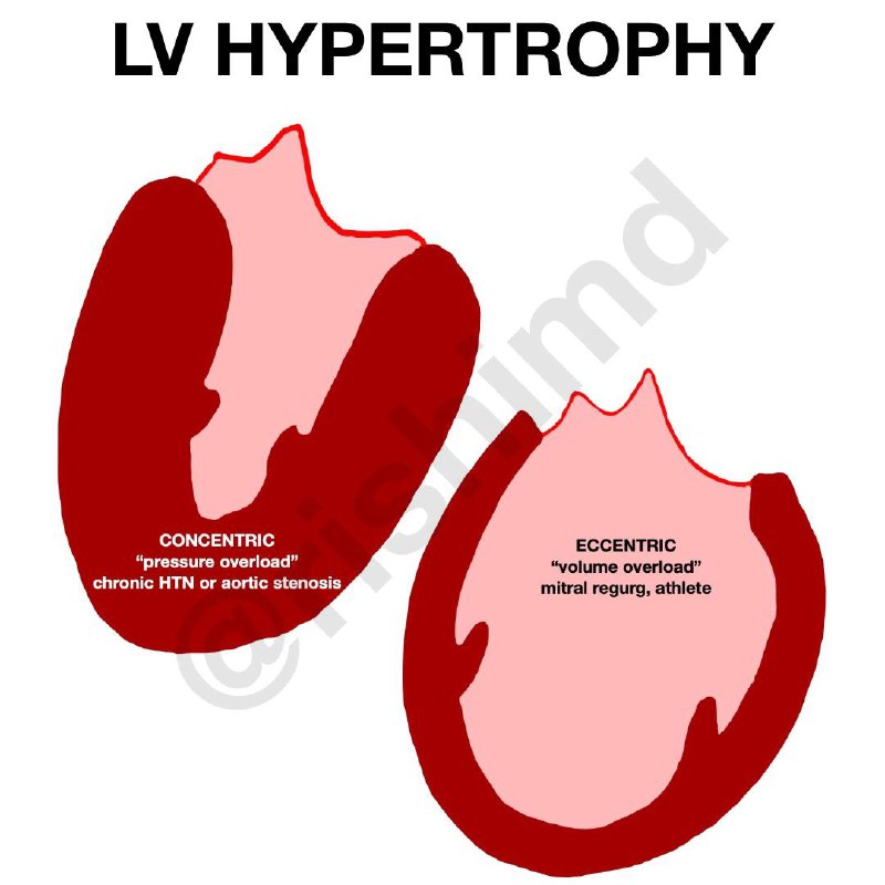 concentric hypertrophy vs eccentric hypertrophy