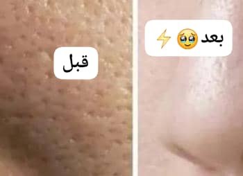 ***🌈*** نتیجه استفاده از ماسک برنج …