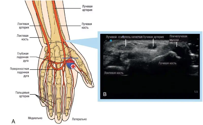 УЗИ при артериальном доступе у постели …