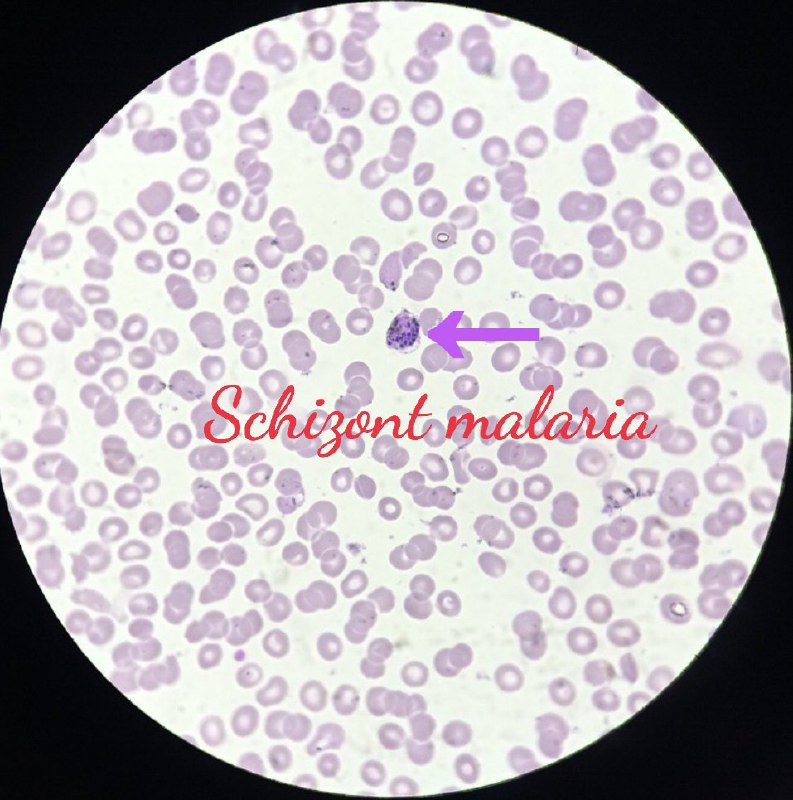 ***🔬***schizont malaria