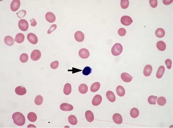 Megaloblastic Anemia