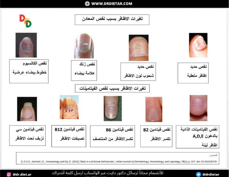 تغيرات الاظافر بسبب نقص الفيتامينات والمعادن