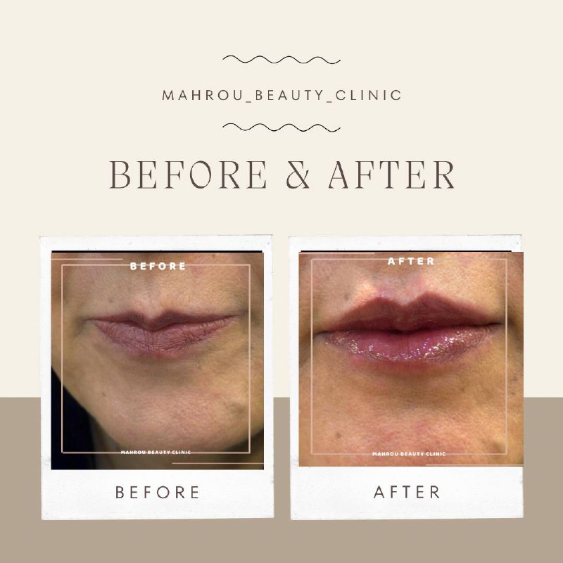 Mahrou_beauty_clinic 👄💉