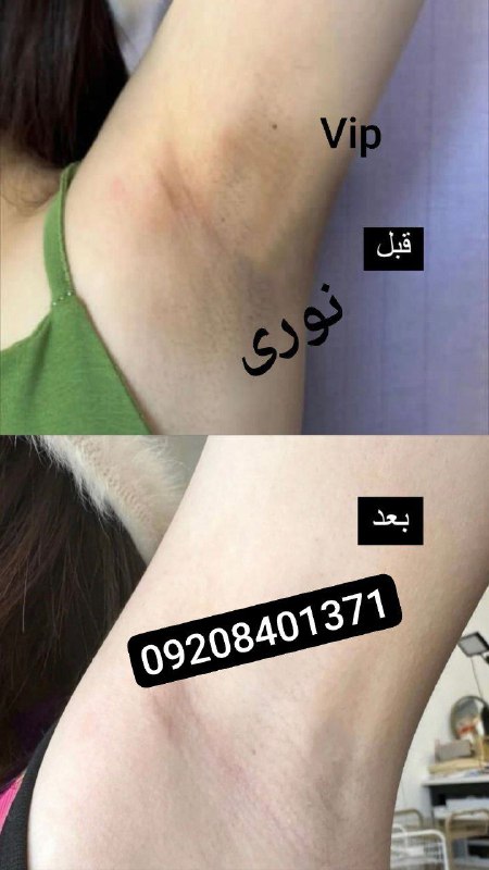 *****👆🏻******🤭***قبل و بعد نواحی حساس**