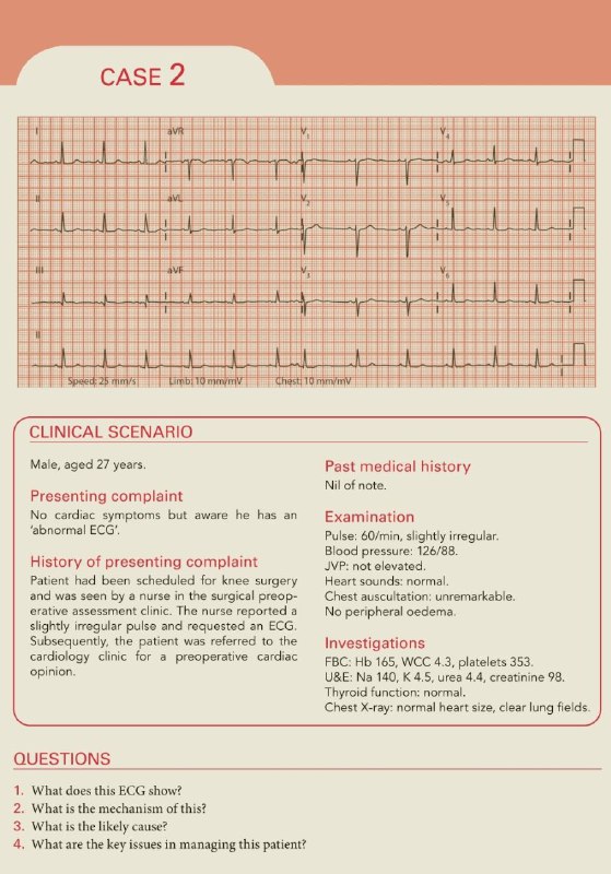 1. What does this ECG show?