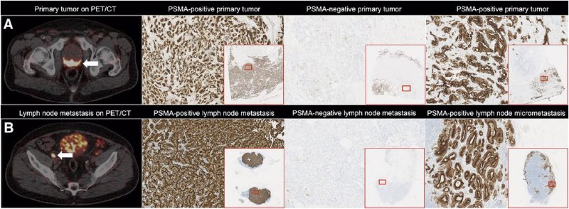 [#PSMA\_PET](?q=%23PSMA_PET) [#Pitfalls](?q=%23Pitfalls) [#Prostate\_cancer](?q=%23Prostate_cancer)