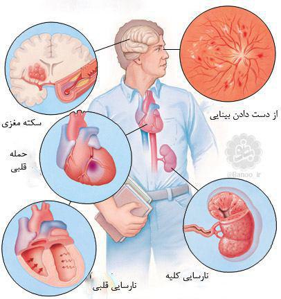 فشار خون بالا، یک قاتل خاموش …