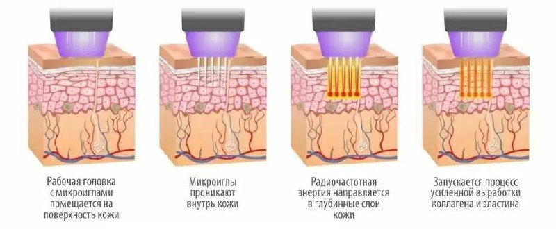 **Игольчатый РФ лифтинг** -