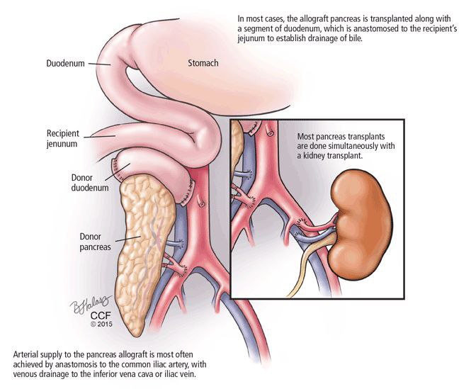 زراعة البنكرياس **Pancreas transplantation**