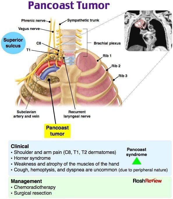 Pancoast tumor