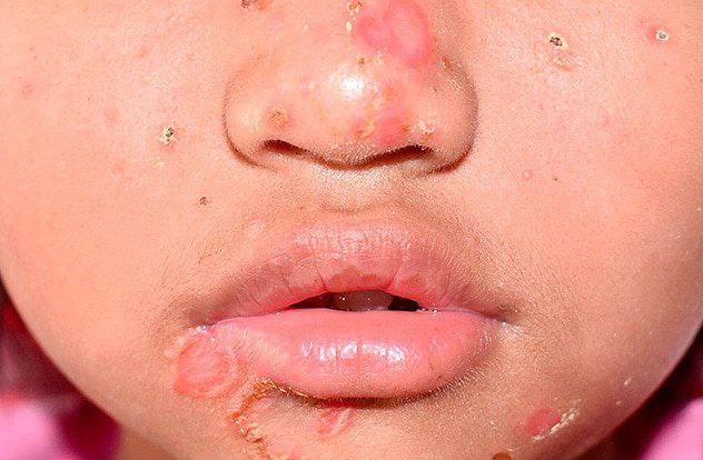 Impetigo contagioso.