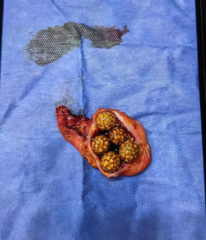 A gallbladder with multiple gallstones
