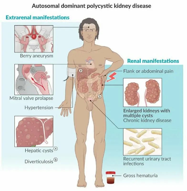 Polycystic Kidney disease