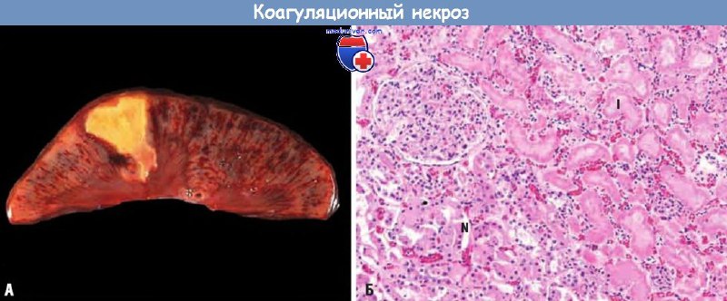 Варианты некроза и их виды