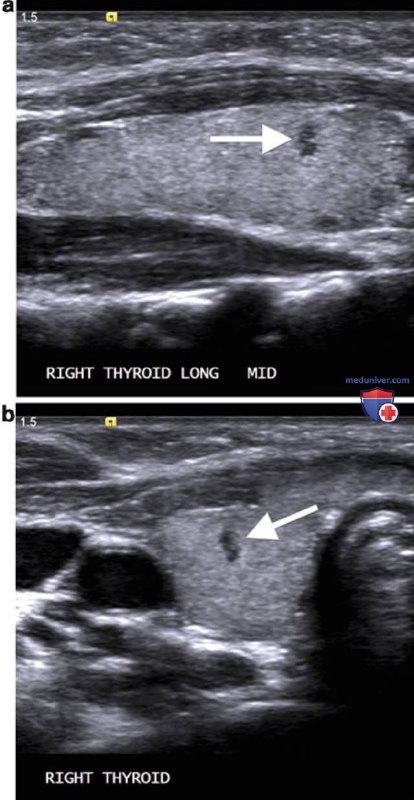 УЗИ врожденных аномалий щитовидной железы у …