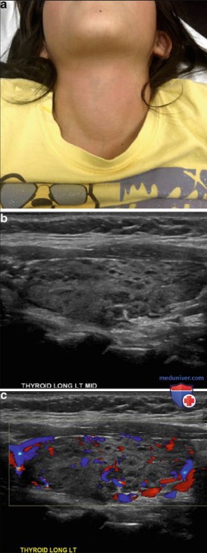 УЗИ диффузных изменений щитовидной железы у …