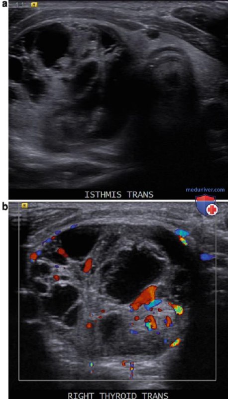 УЗИ очаговых изменений щитовидной железы у …