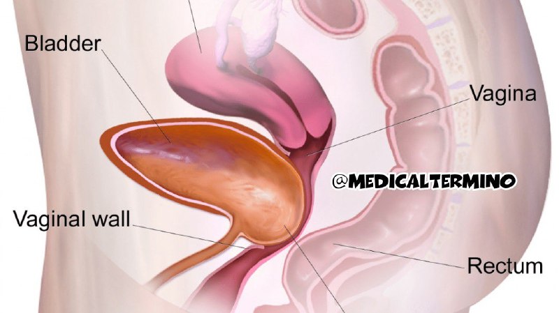 **Cystocele**