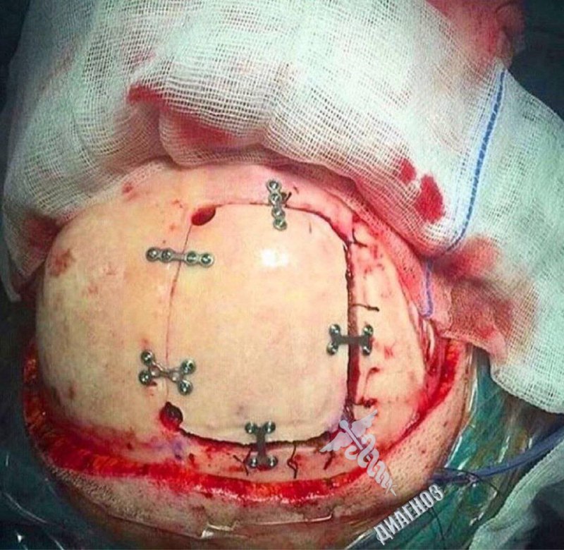 Craneoplastia después de una cirugía cerebral.