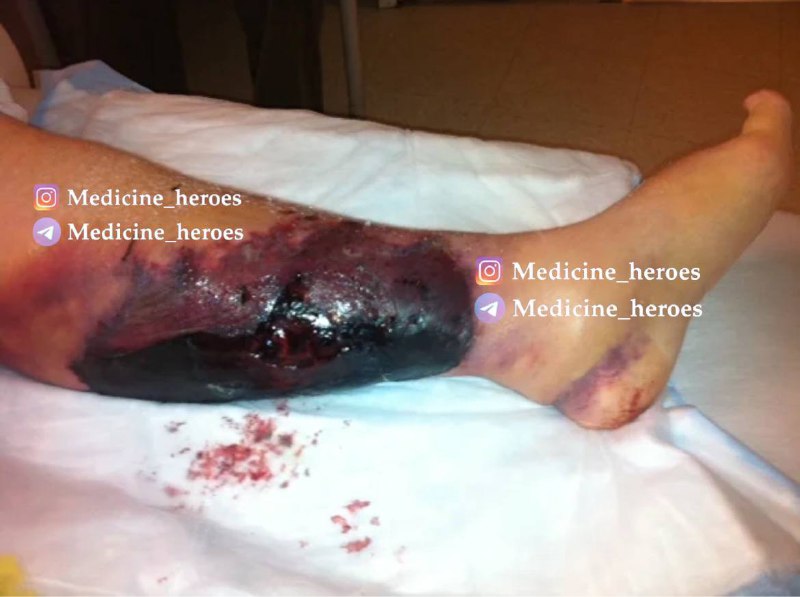 **Warfarin-Induced Skin Necrosis