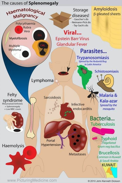 [#splenomegaly](?q=%23splenomegaly)