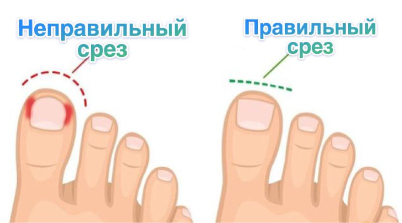 *****🦶***КАК ПРАВИЛЬНО ПОСТРИГАТЬ НОГТИ НА НОГАХ …